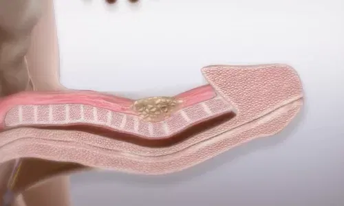 Acabe con la enfermedad de Peyronie